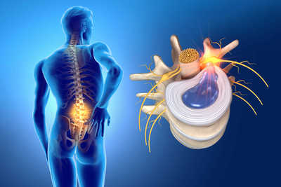 Disc Herniation Bulge