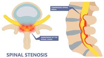 Spinal Stenosis