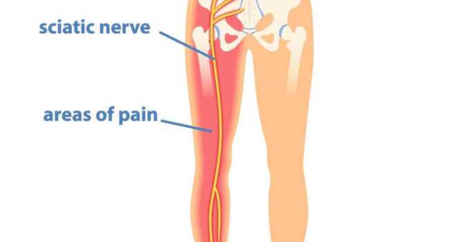 Understanding Sciatica: Causes, Symptoms, and Effective Treatments image