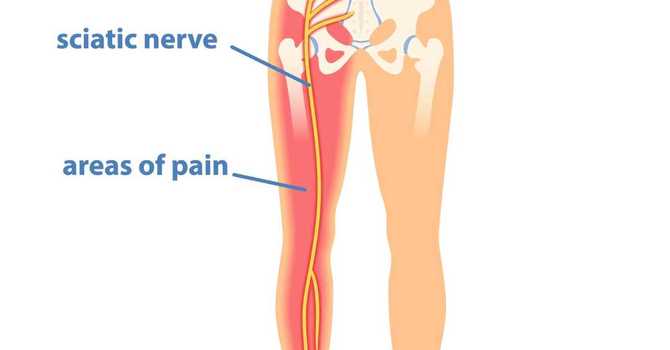Understanding Sciatica: Causes, Symptoms, and Effective Treatments