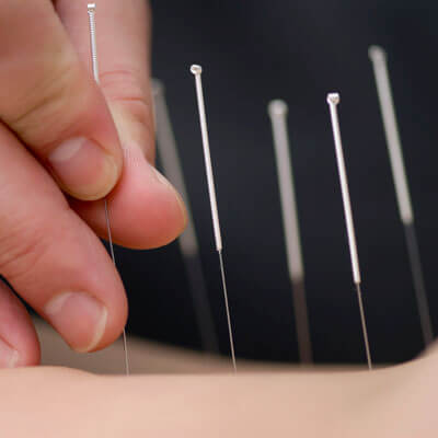 Dry Needling Acupuncture