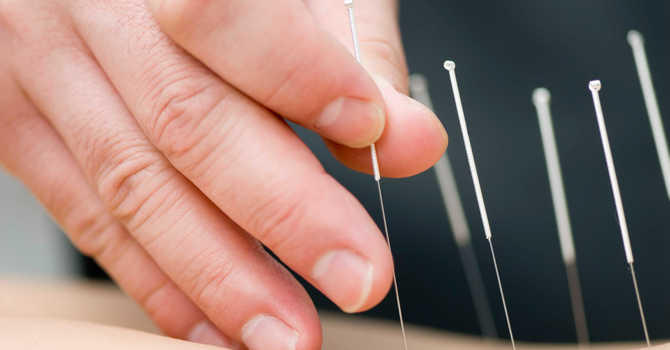 Your Top Questions About Dry Needling – Answered image