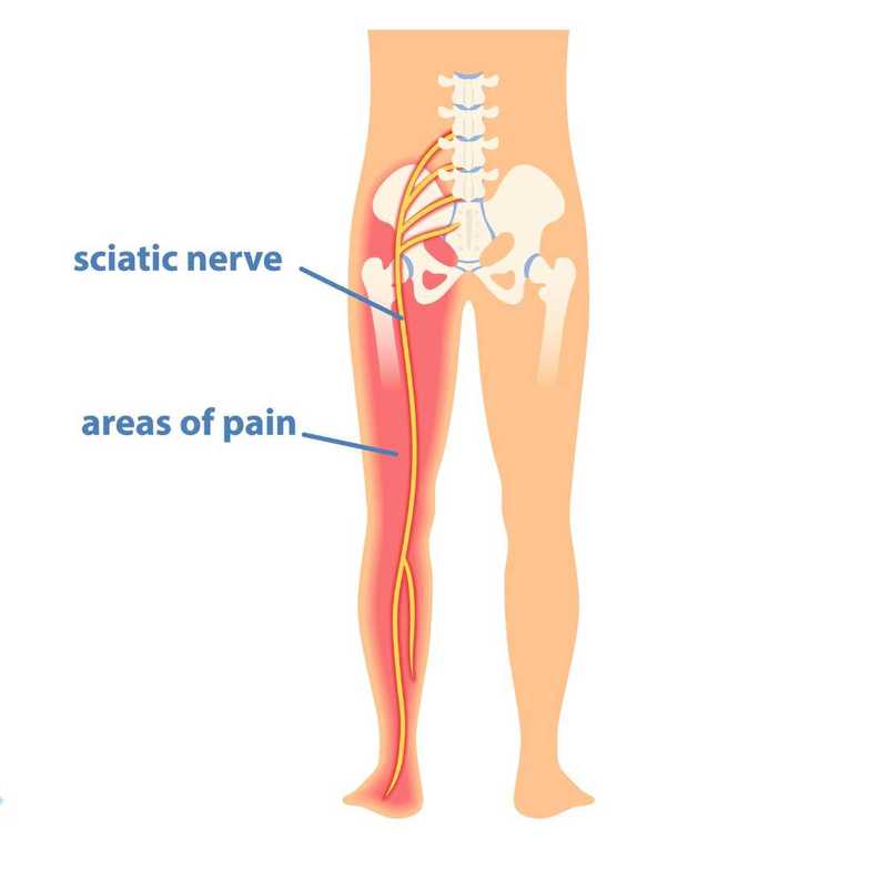 Sciatica