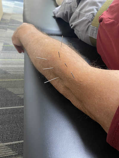 Dry Needling in Rochester, MN