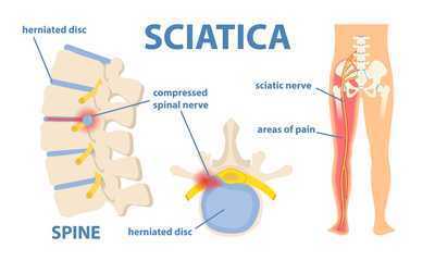 sciatica
