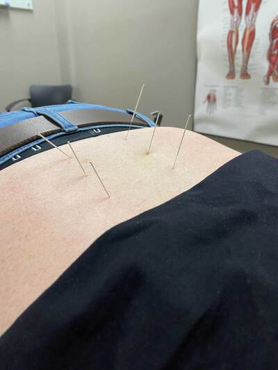 dry needling 
