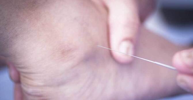 Dry Needling vs. Acupuncture: Understanding the Differences and How Skare Spine & Performance Can Help image