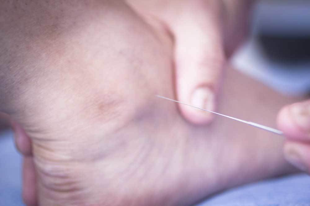 dry needling 