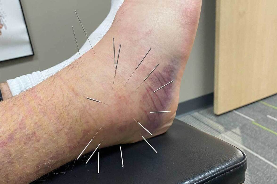 sports injury recovery